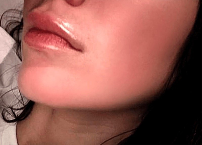 img/2020/03/udalenie-pryshey-photo-17.png 800x574