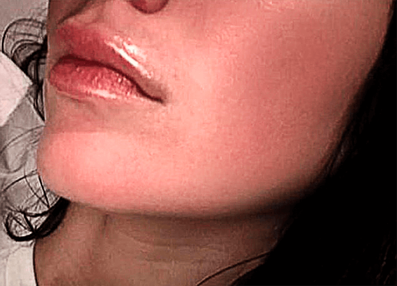 img/2020/03/udalenie-pryshey-photo-29.png 800x576