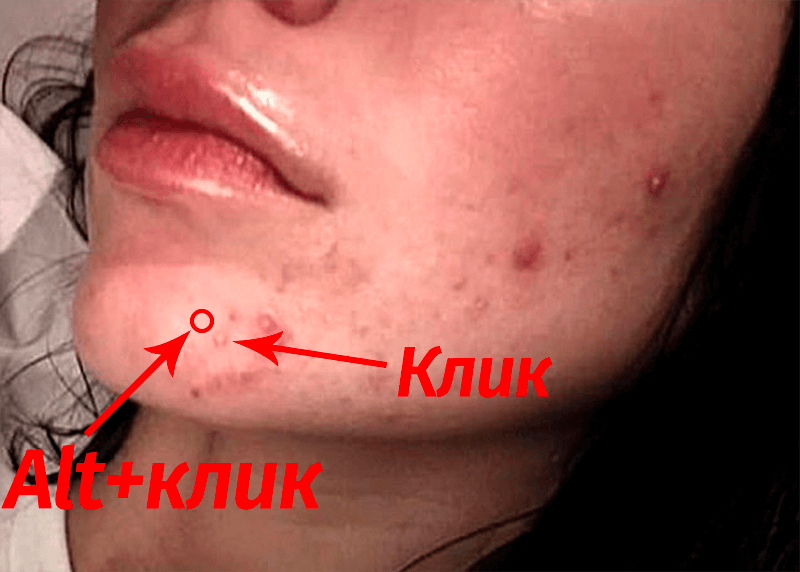 img/2020/03/udalenie-pryshey-photo-5.png 800x572