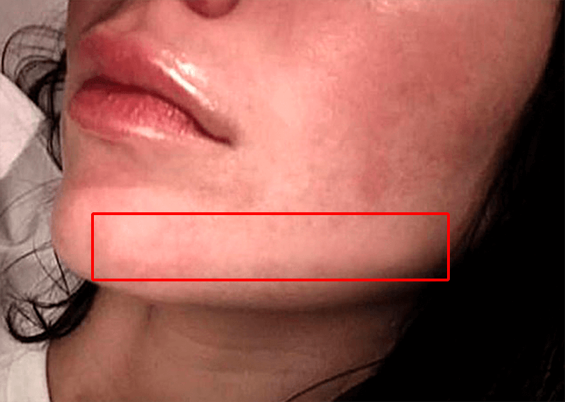 img/2020/03/udalenie-pryshey-photo-9.png 800x570